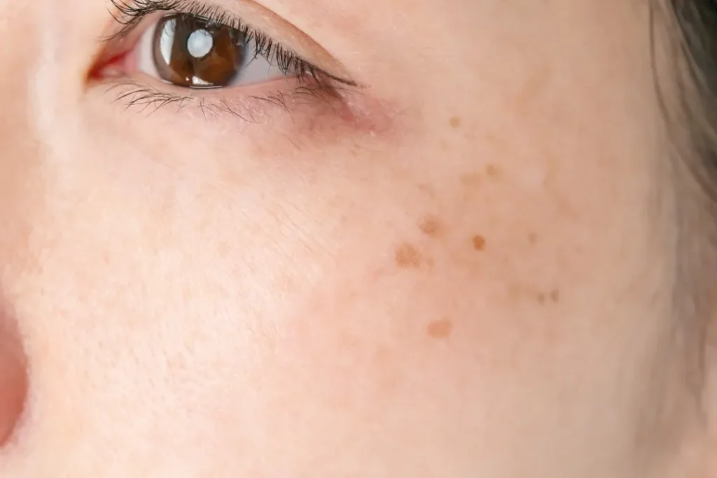 ملاسما یک نوع از لکهای پوستی است که اغلب به صورت لکههای قهوهای یا خاکستری بر روی صورت ظاهر میشود.