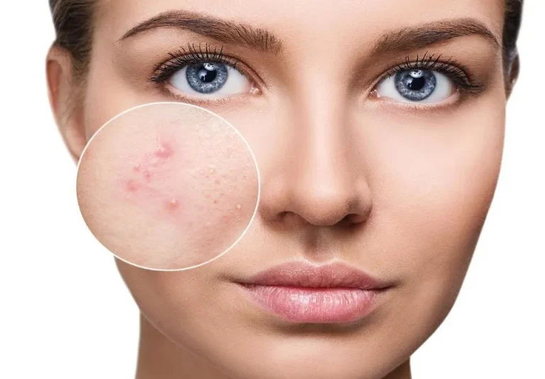ضد جوش اورژانسی راهکار سریع برای جوش‌ ناگهانی