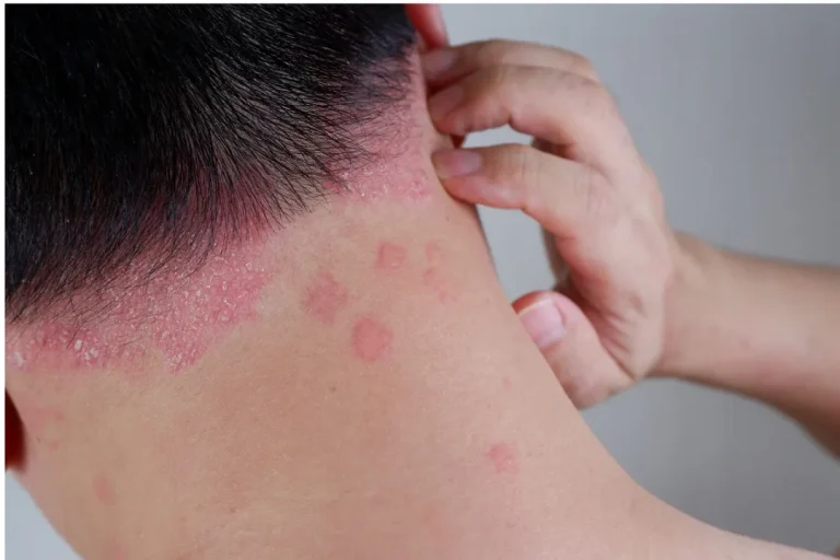 شامپو ضد قارچ: همه چیز درباره درمان قارچ‌های پوست سر