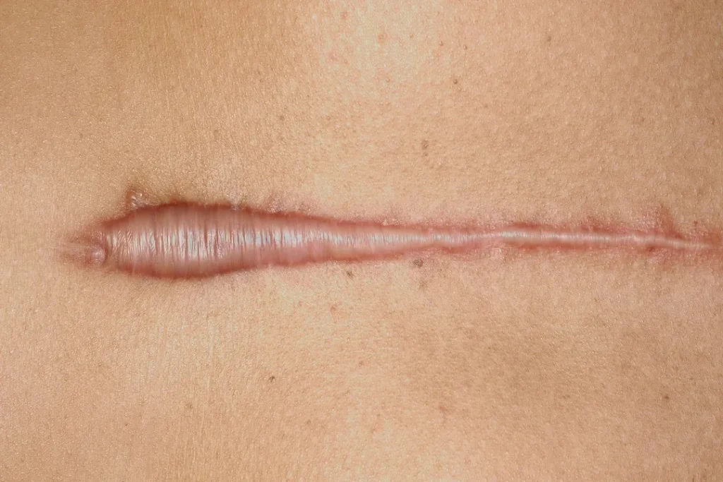 کلوئید و درمان آن، هر آنچه باید بدانید