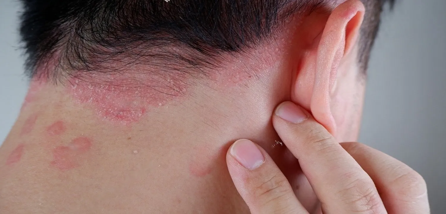 شامپوهای ضد قارچ به‌طور معمول حاوی ترکیبات ضد التهابی هستند که به کاهش خارش و قرمزی پوست سر کمک می‌کنند.