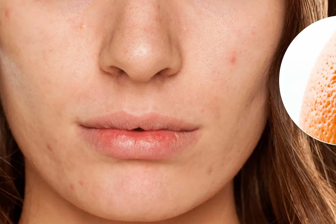 برخی از محصولات ماتکننده ممکن است منافذ پوست را ببندند و باعث ایجاد جوش شوند.