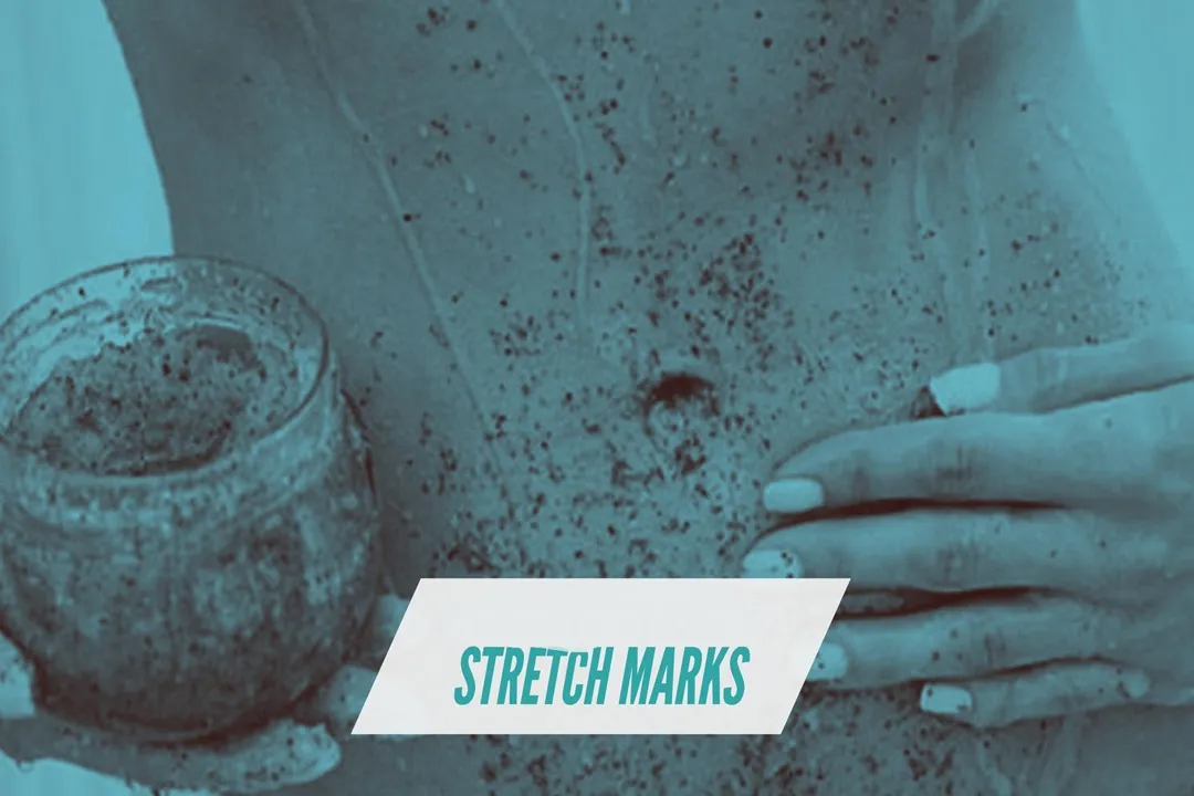 با استفاده از مواد شیمیایی مخصوص، لایه بالایی پوست برداشته می‌شود و پوست تازه و سالم زیرین ظاهر می‌شود.