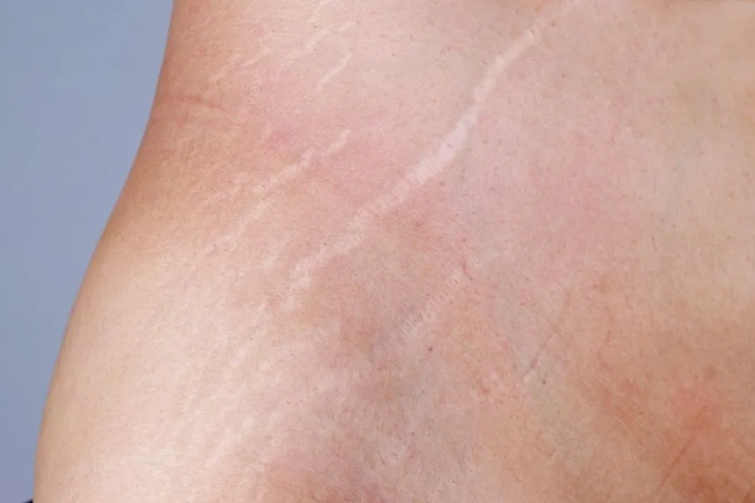 ترک‌های بدن (استرچ مارک‌ها) خطوط نازک و باریک هستند که ممکن است بر اثر تغییرات مختلفی روی پوست ایجاد شوند.