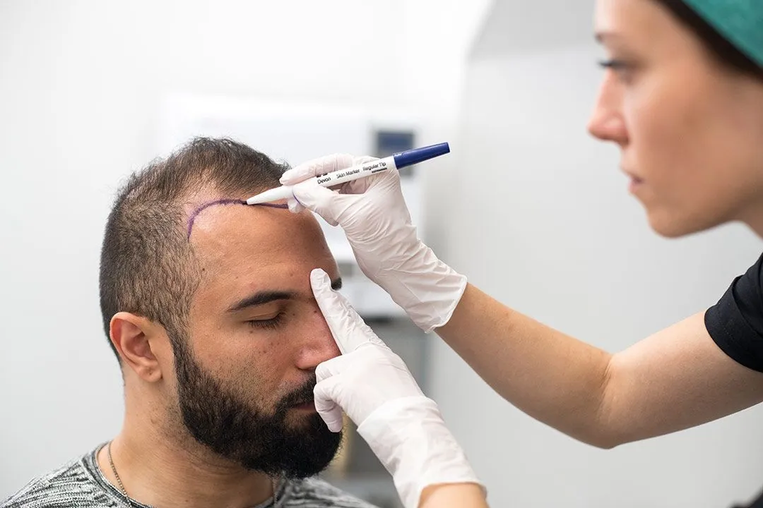 کاشت مو یکی از روشهای موثر برای بازگرداندن موهای از دسترفته و افزایش اعتمادبهنفس است.