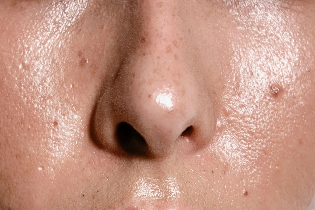 چربی اضافی پوست میتواند منافذ را مسدود کند و به ایجاد جوش و آکنه منجر شود.