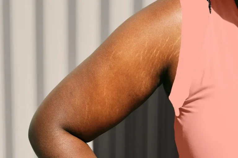 ا توجه به این که ترک‌های بدن یک مشکل شایع و گاه اجتناب‌ناپذیر است، بهترین راه برای مدیریت آن، پذیرش این تغییرات در بدن و انجام روش‌های پیشگیرانه و درمانی به صورت منظم است.