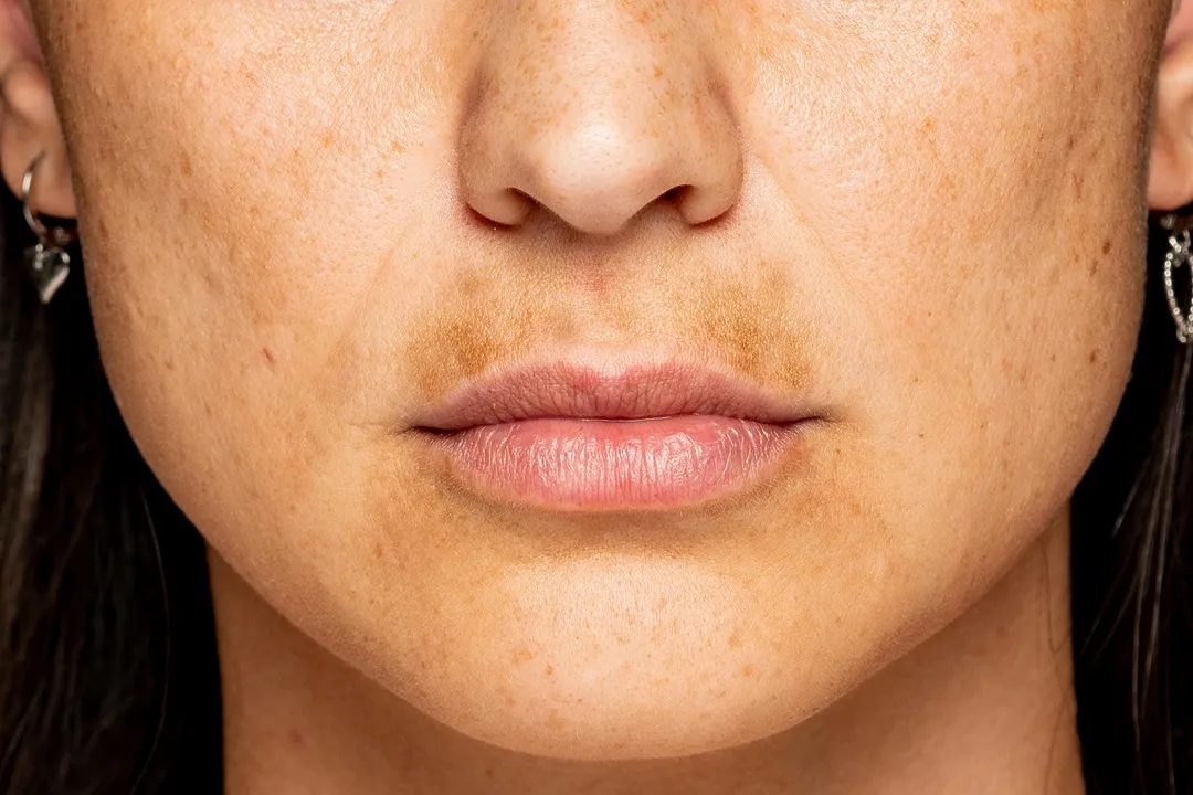 استفاده منظم از سالیسیلیک اسید میتواند به کاهش لکههای تیره و هیپرپیگمانتاسیون (Hyperpigmentation) کمک کند.