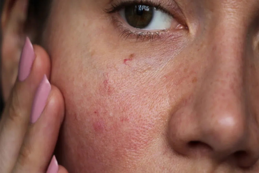 اگر پوست حساسی دارید، از محصولاتی که به طور خاص برای پوستهای حساس فرموله شدهاند استفاده کنید
