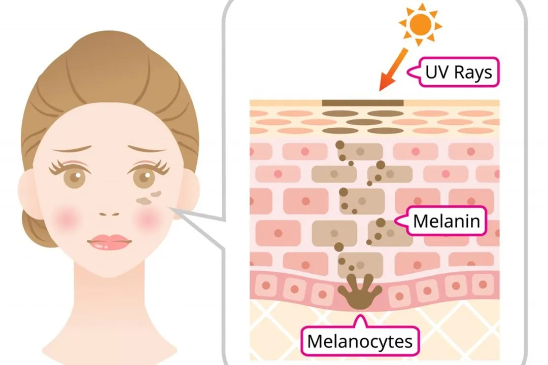 اشعه فرابنفش (UV) باعث تخریب کلاژن و ایجاد لکهای پوستی میشود.