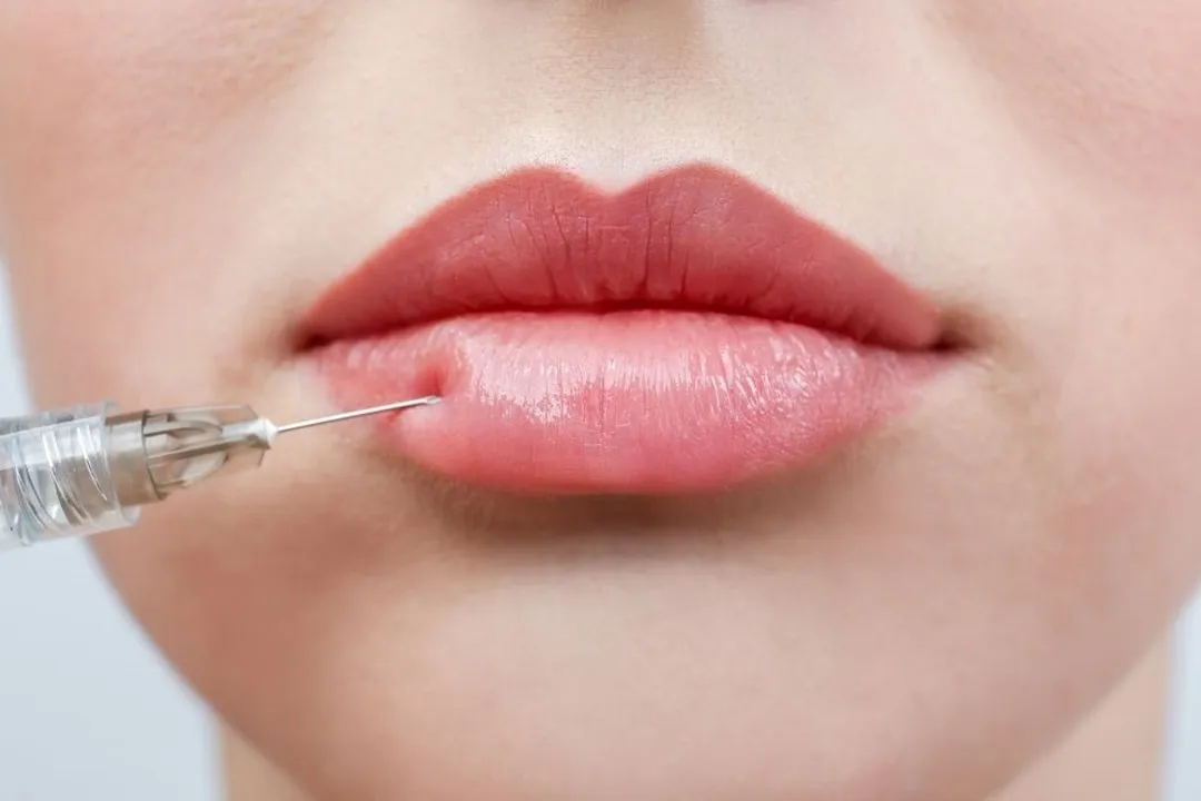 زریق ژل یا فیلر یکی از متداولترین تکنیکهای حجمدهی لبها است.