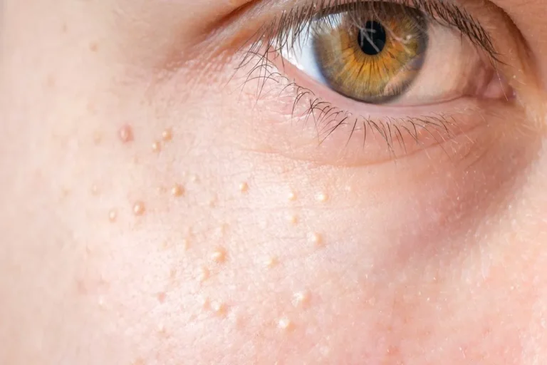چگونه از ایجاد میلیا پیشگیری کنیم؟