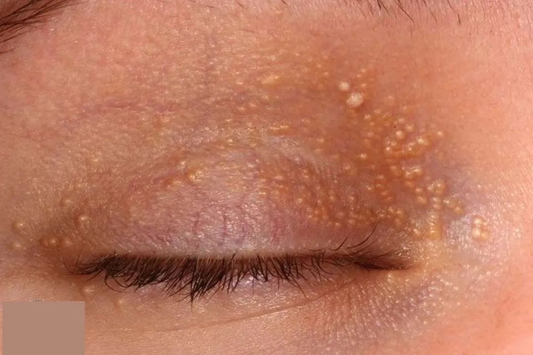 دانههای کوچک سفیدی روی پوست صورت، به ویژه اطراف چشمها، میلیا میگویند
