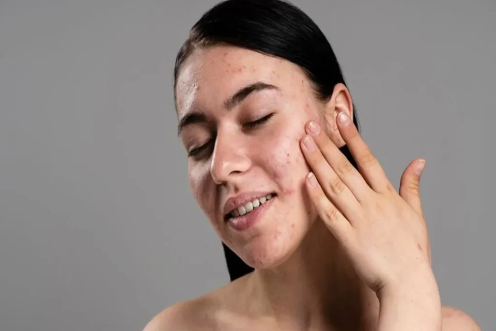 کرم کنترل سبوم راهکار مؤثر برای پوست‌های چرب و مستعد آکنه