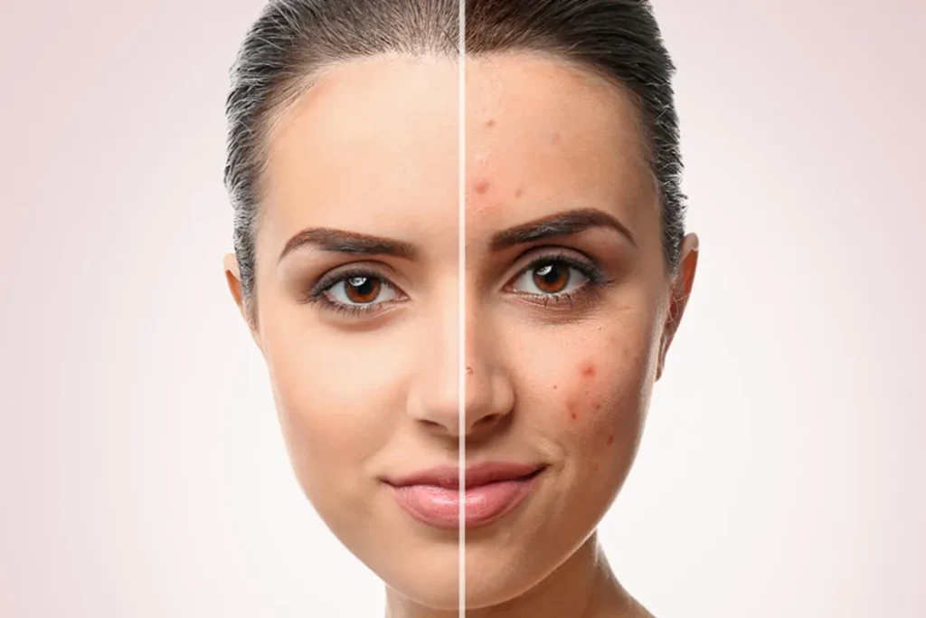 خداحافظی با لک و جای جوش برای همیشه