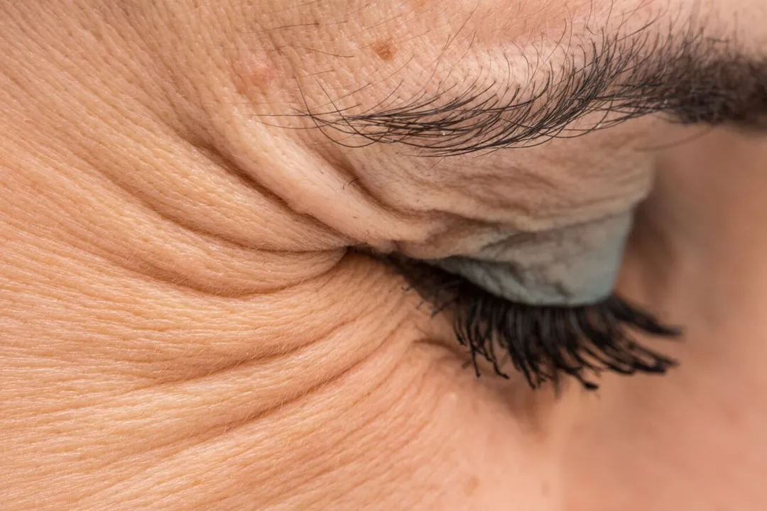 خطوط ریز و چروک‌هایی که در گوشه چشم ظاهر می‌شوند خطوط پنجه کلاغی هستند