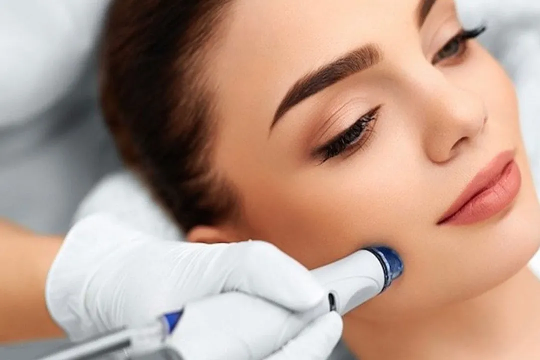 میکرودرم ابریژن یک فرایند لایه‌برداری مکانیکی پوست است