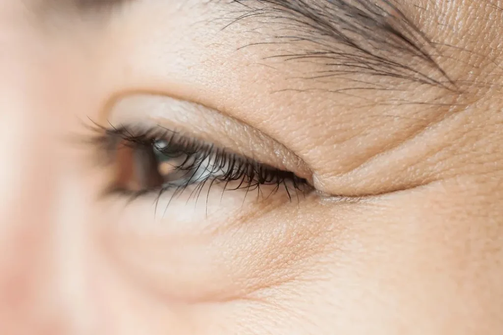 درمان و کاهش خطوط پنجه کلاغی دور چشم